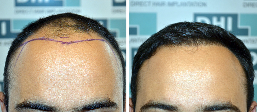 DHI before & after hair transplant results